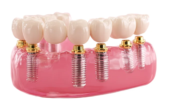 Implantes Dentales All-on-6: Soporte más fuerte, vida más larga