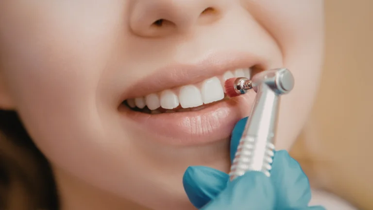 Blanqueamiento Dental: Profesional vs Casero